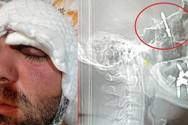 Bursa’da inanılmaz olay: Dişçiye gitti, hayatı kabusa döndü! Neredeyse ölüyordu